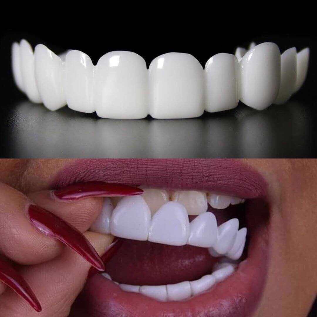 Snap On Veneers